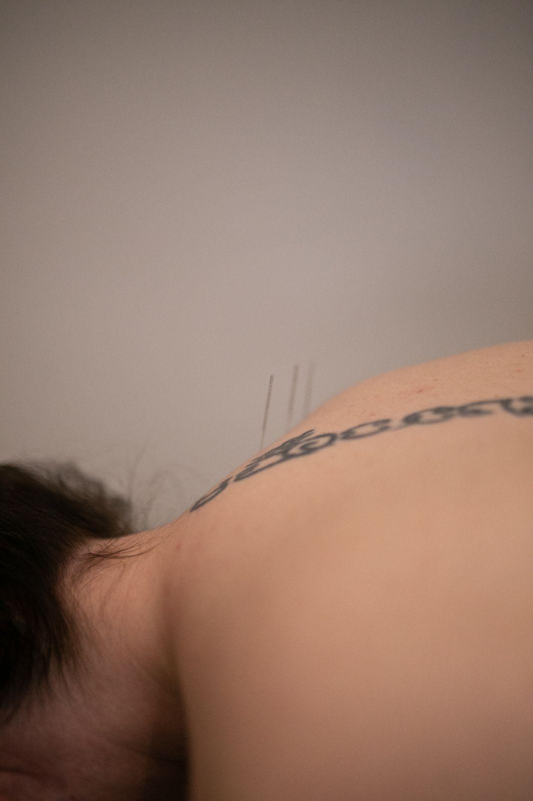 Dry Needling